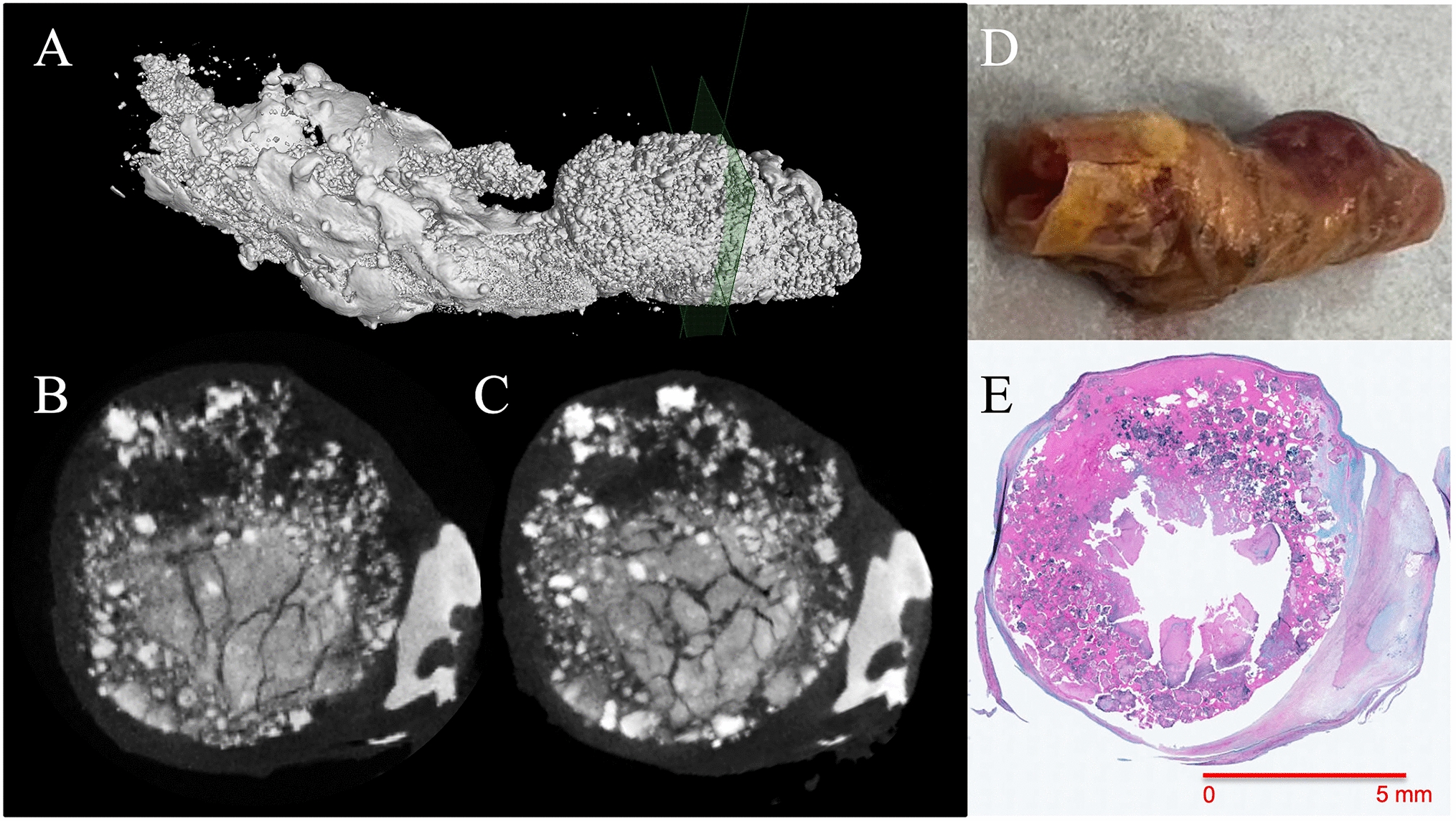 Ex vivo micro-computed tomography analysis of the fracking technique for a nodular calcification in the common femoral artery