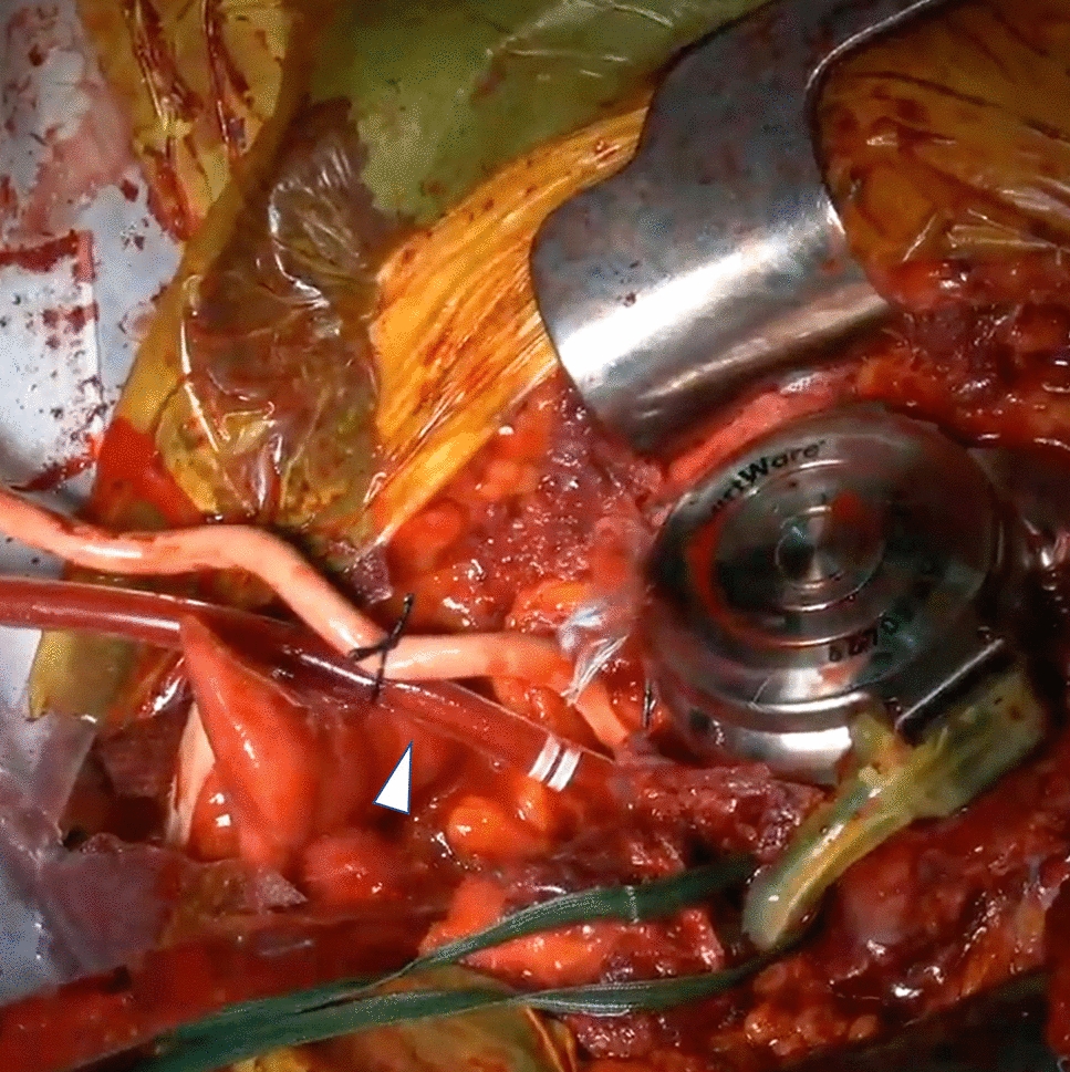 Successful resuscitation from restart failure of left ventricular assist device in a patient with aortic valve closure
