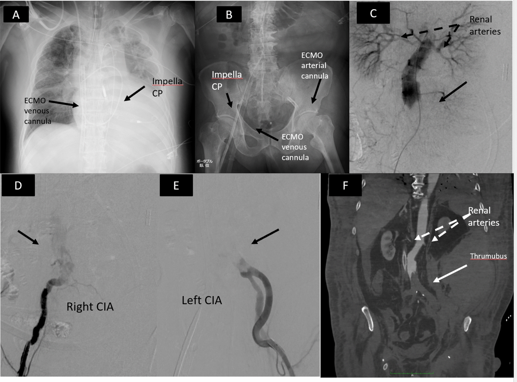A case of fatal acute saddle embolism of the terminal aorta after long-term support using Impella CP