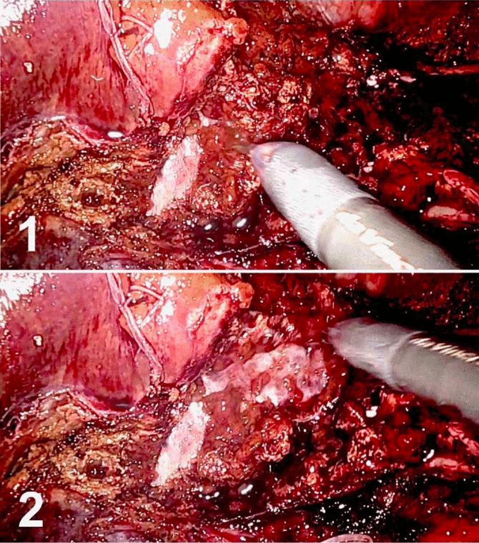 Pencil cleaning technique for robotic liver parenchymal transection: a step further to systematization beyond the microfracture-coagulation method
