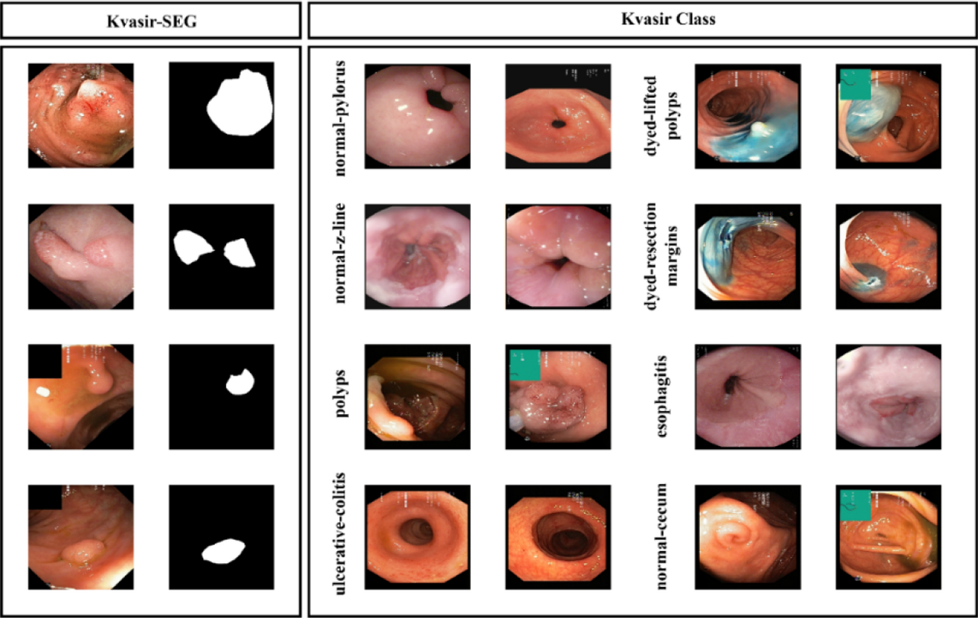 Automatic detection of gastrointestinal system abnormalities using deep learning-based segmentation and classification methods