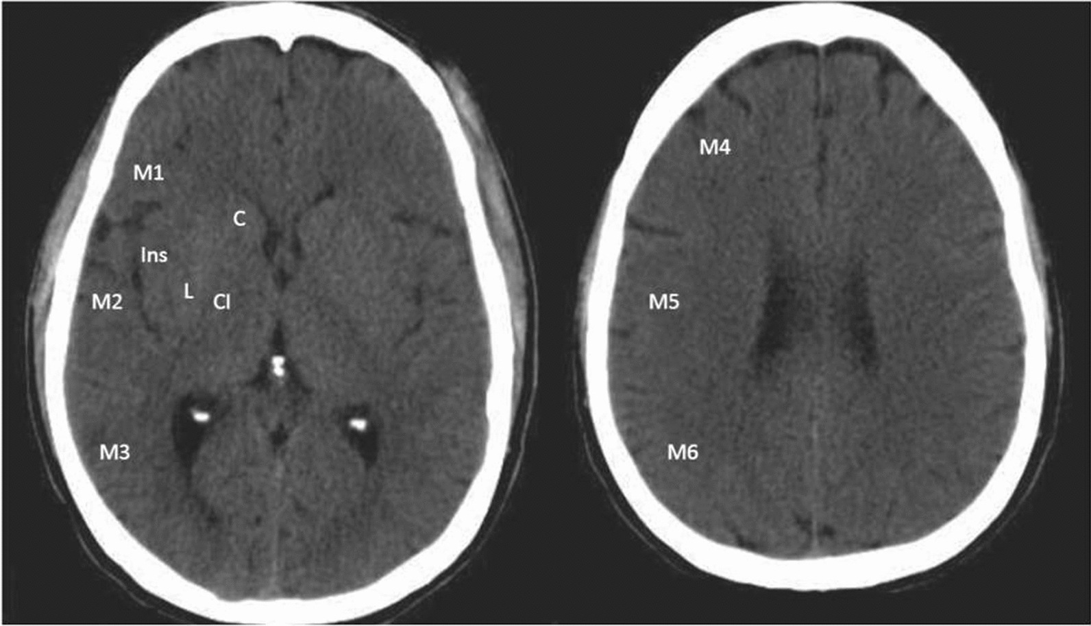 Cerebral ischemia detection using deep learning techniques