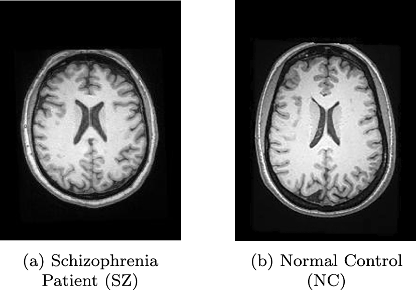 Spatial and frequency domain-based feature fusion for accurate detection of schizophrenia using AI-driven approaches