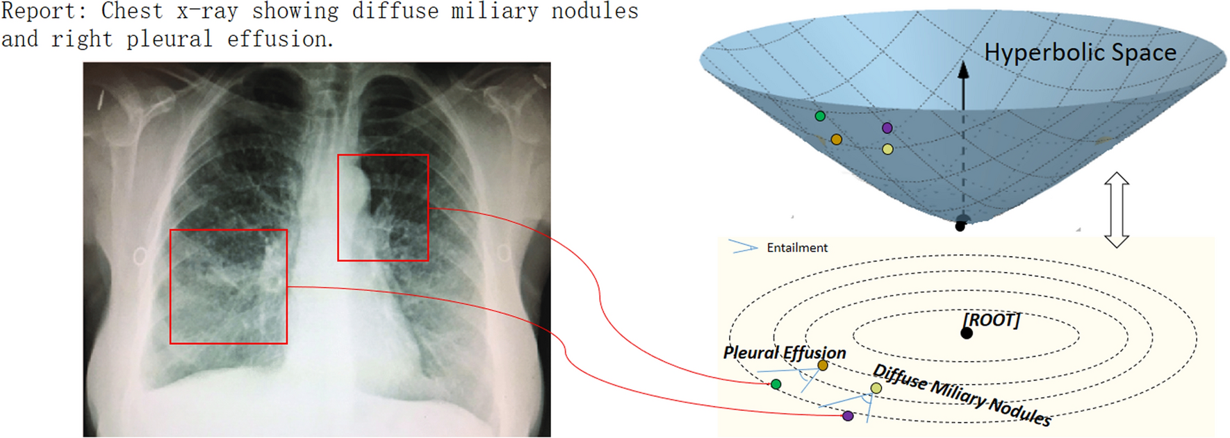 Hyperbolic vision language representation learning on chest radiology images