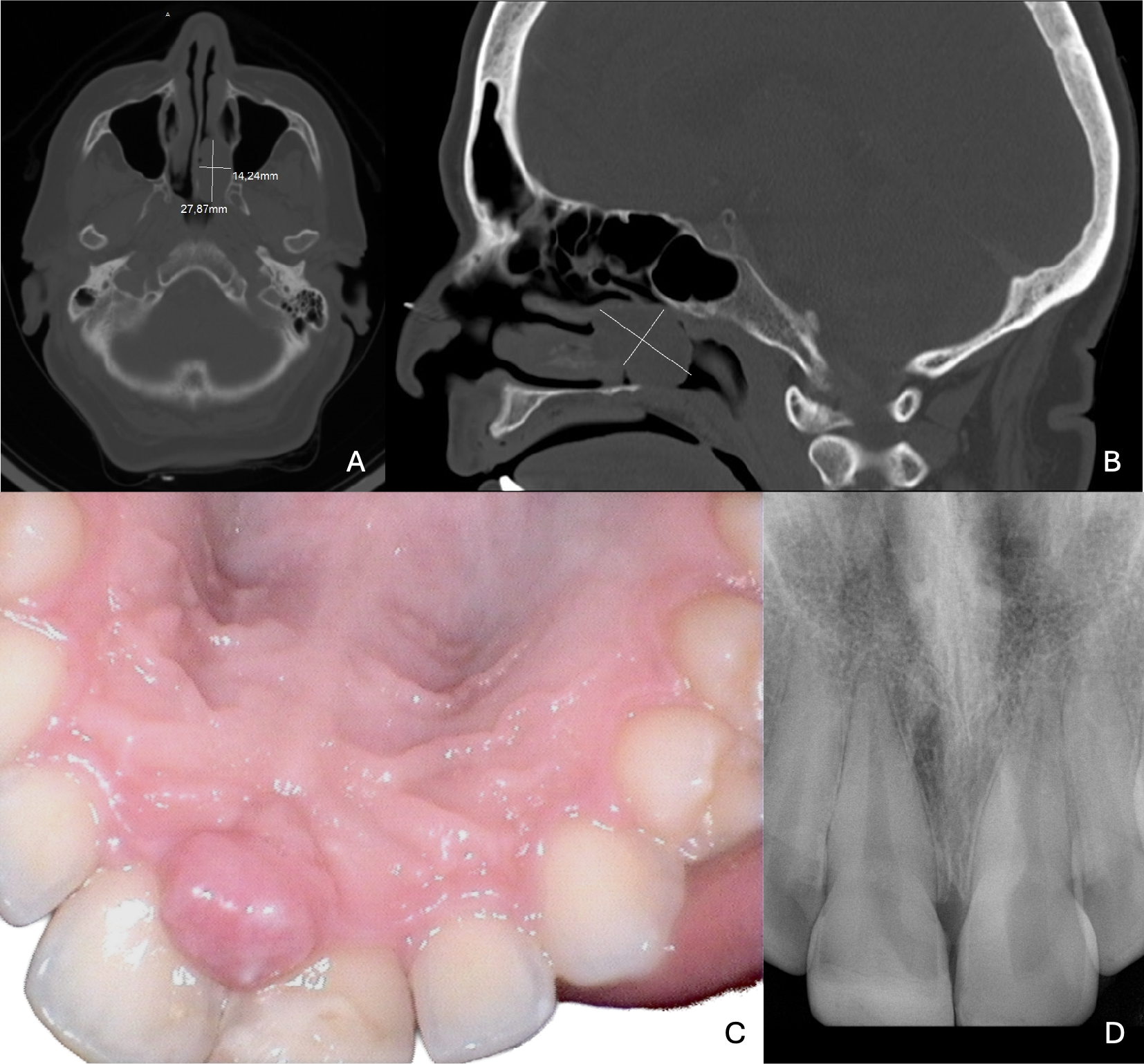 Unusual Locations of Extra-Glossal Ectomesenchymal Chondromyxoid Tumors with  Gene Fusions: A Report of Two Cases