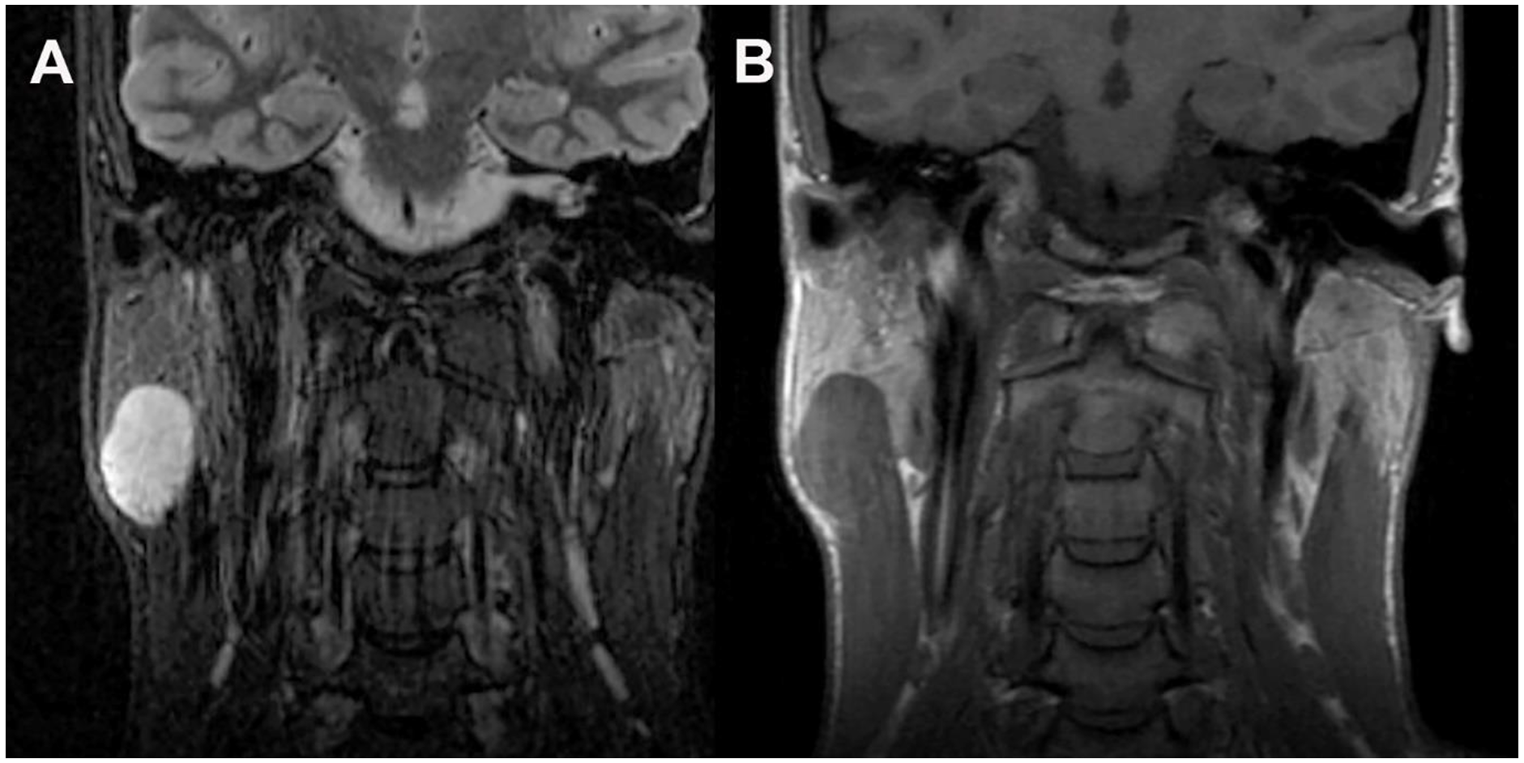 Metastatic Intraparotid Balloon Cell Melanoma: A Diagnostic Challenge