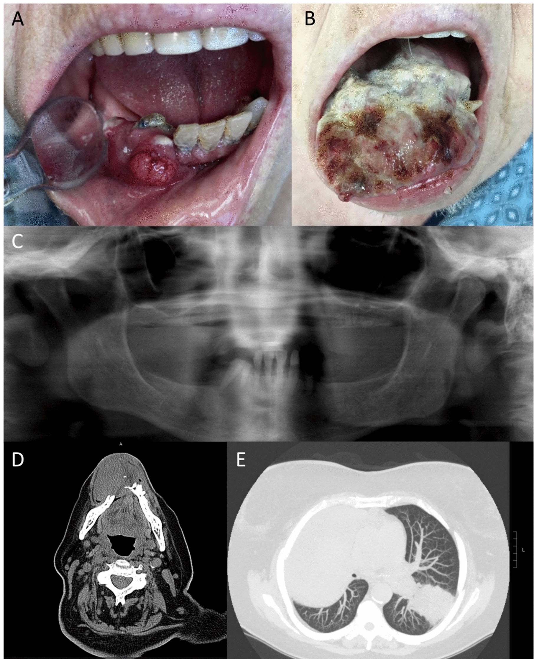 Metastatic SMARCA4-Deficient Undifferentiated Carcinoma of the Oral Cavity: A Case Report and Review of Literature