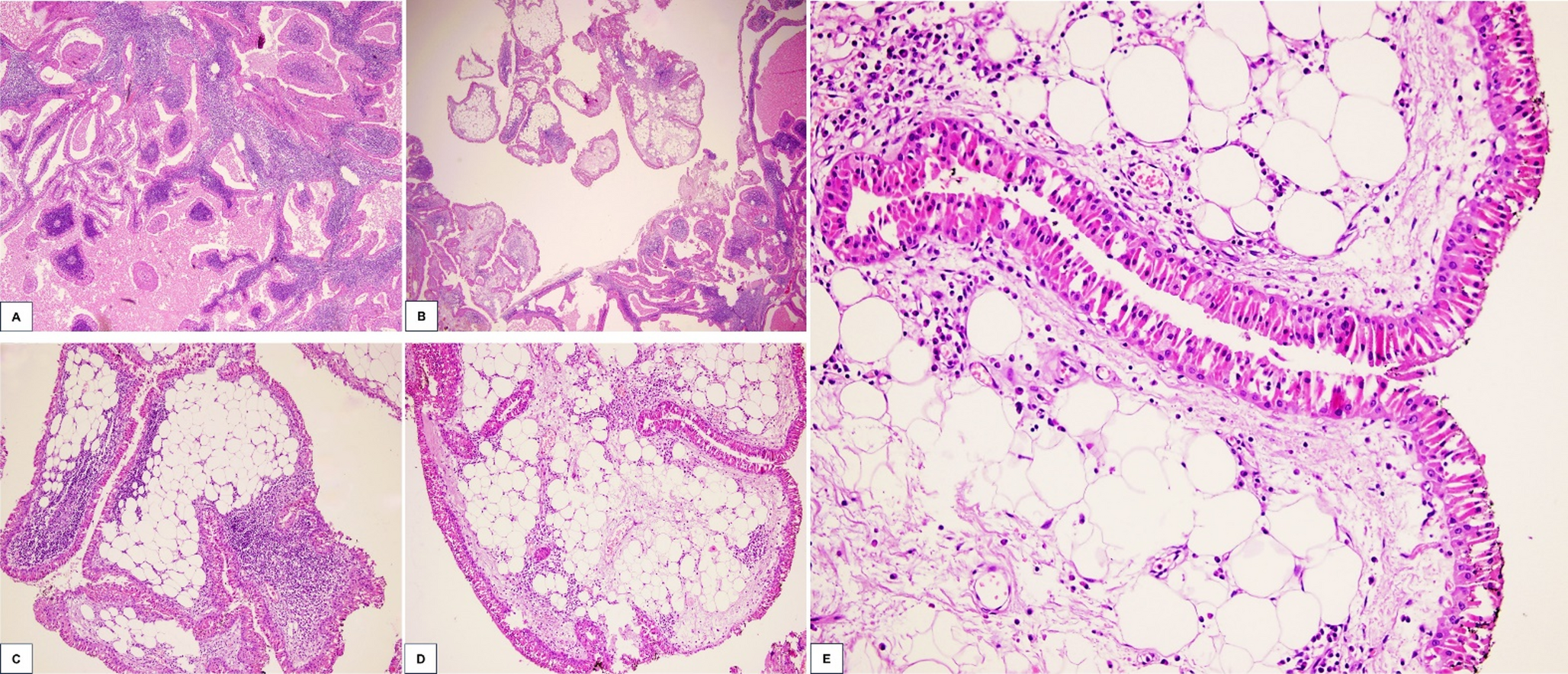 Lipomatous Metaplasia in a Warthin Tumor: A Rare Histopathological Finding