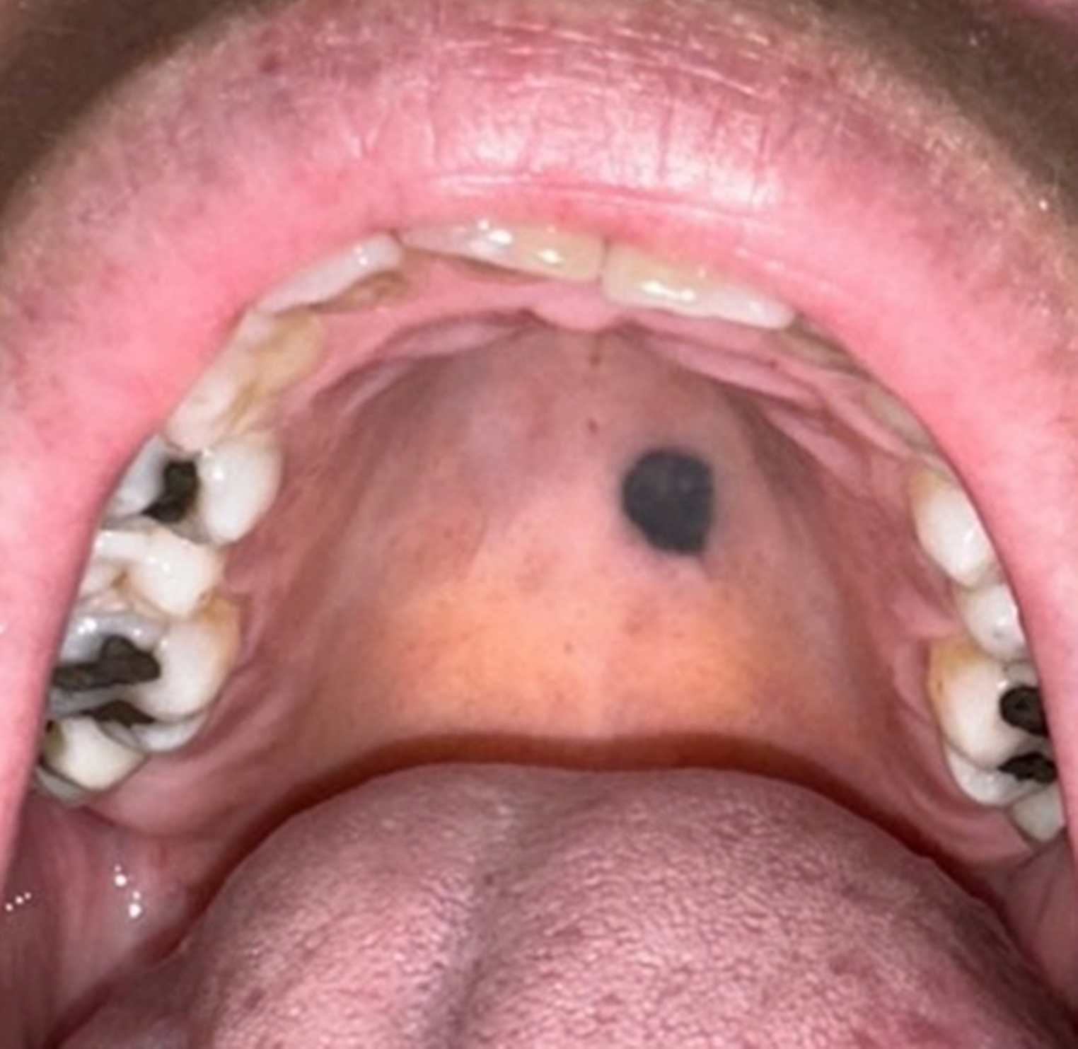Blue Nevus of The Palate: A Case Image