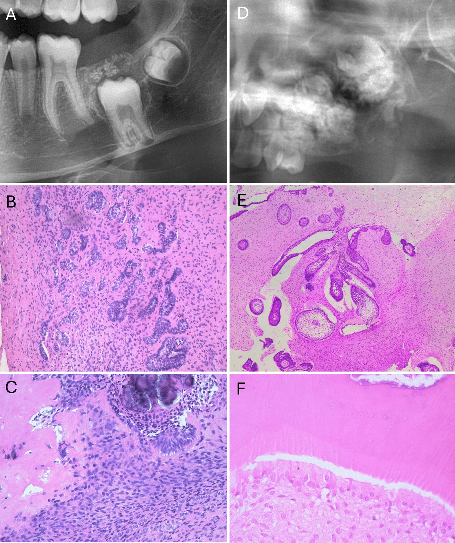 Rethinking Ameloblastic Fibroma and Fibro-odontoma: A Serie of 6 Cases and Reclassification Proposal