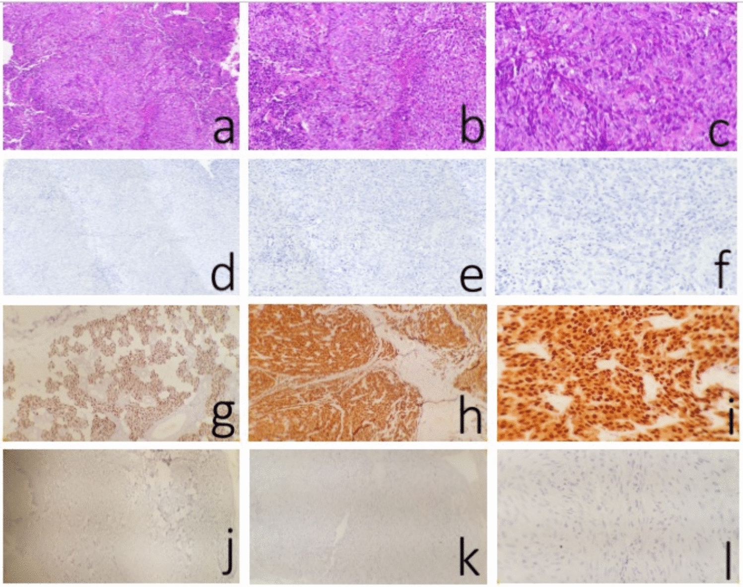 Expression of SOX10, and micro-RNA 221 and Micro-RNA 222 in Oral Squamous Cell Carcinoma and Correlation with Clinicopathological Characteristics