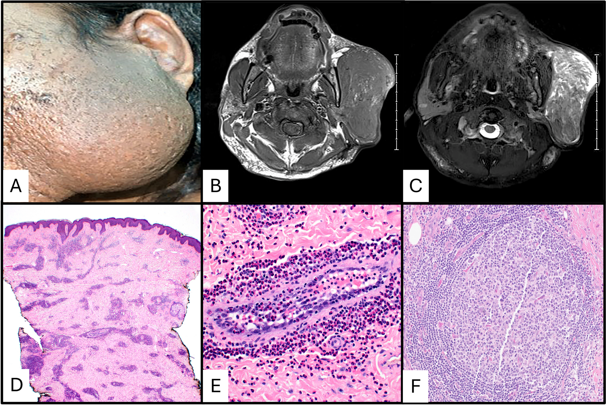 A Comprehensive Review of Kimura Disease