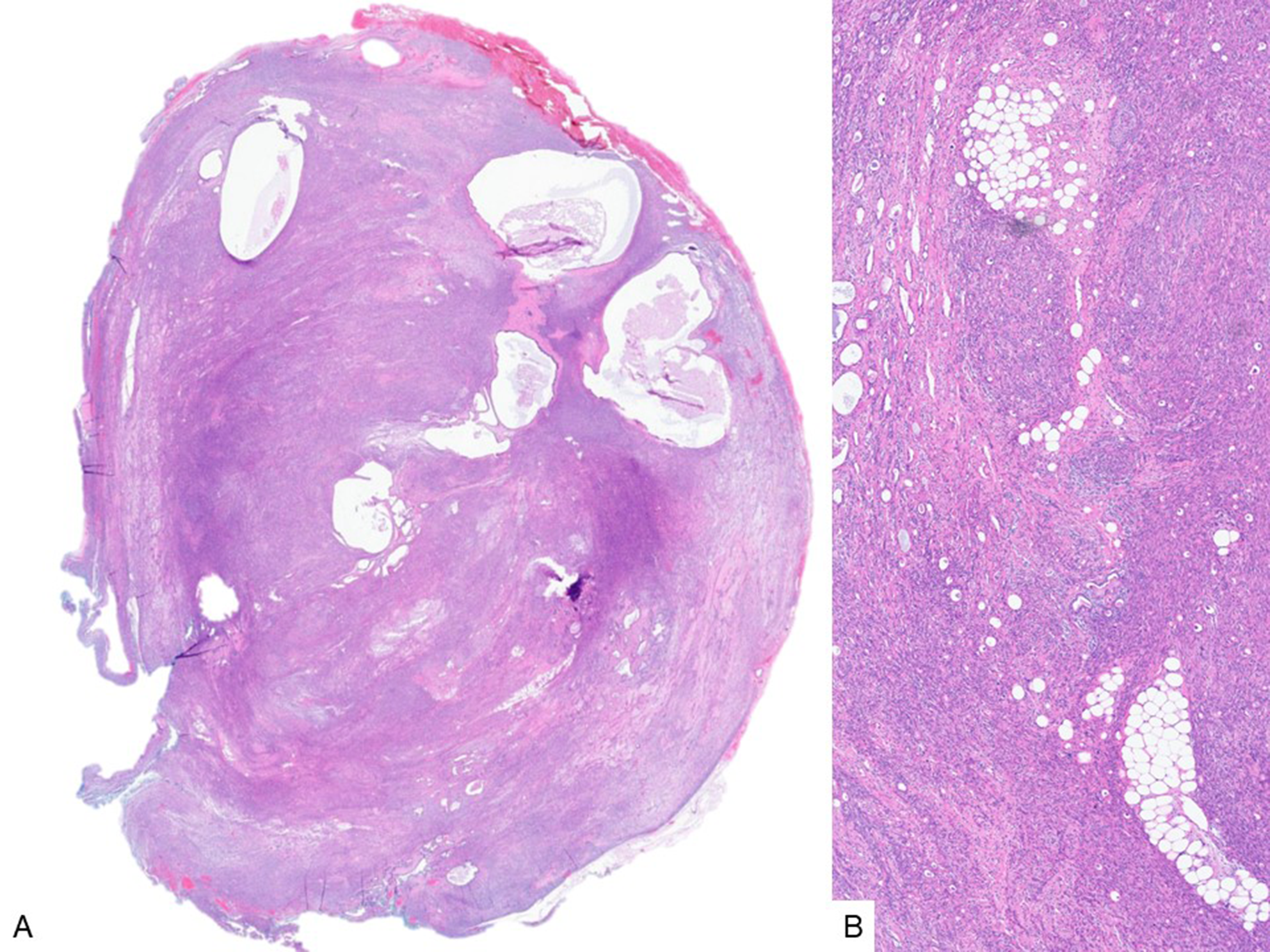 Branchioma: A Classic Example