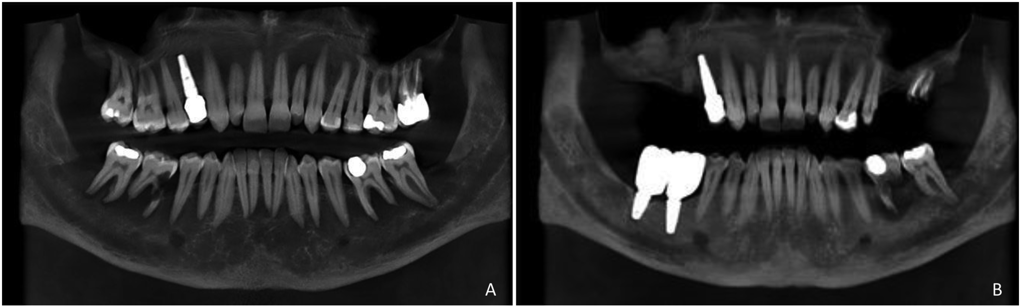 Erdheim-Chester Disease of the Jaws: A Case Report and Review of the Literature