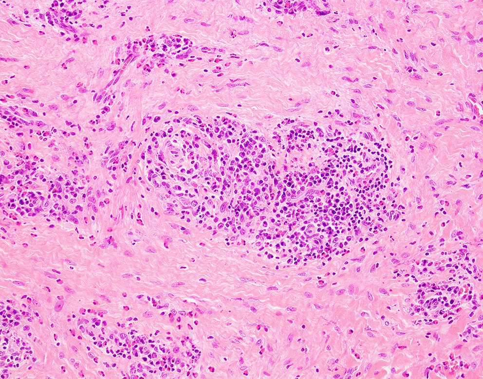 Eosinophilic Angiocentric Fibrosis: An Uncommon Entity in the Spectrum of IgG4-related Disease