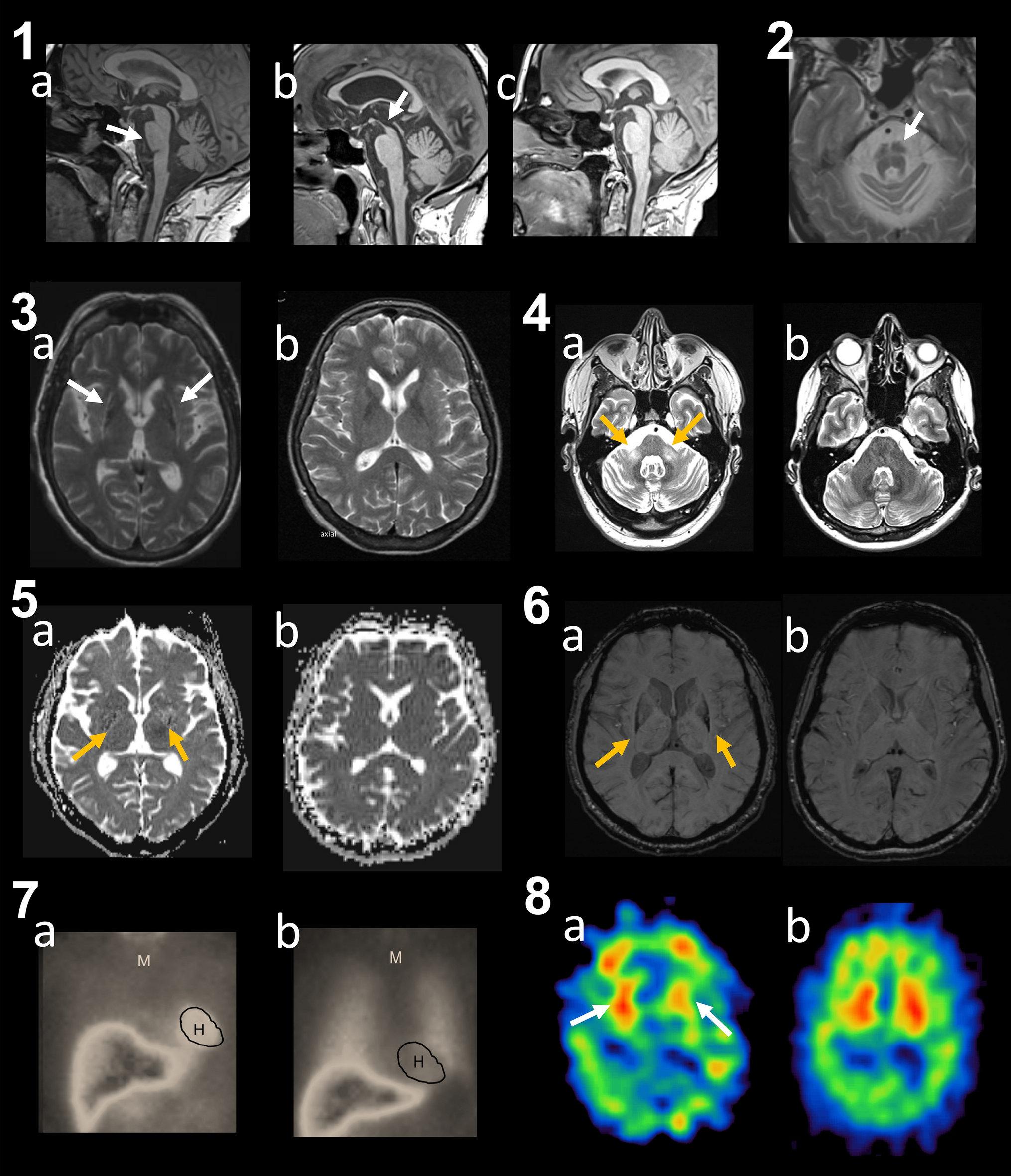 The role of neuro-imaging in multiple system atrophy