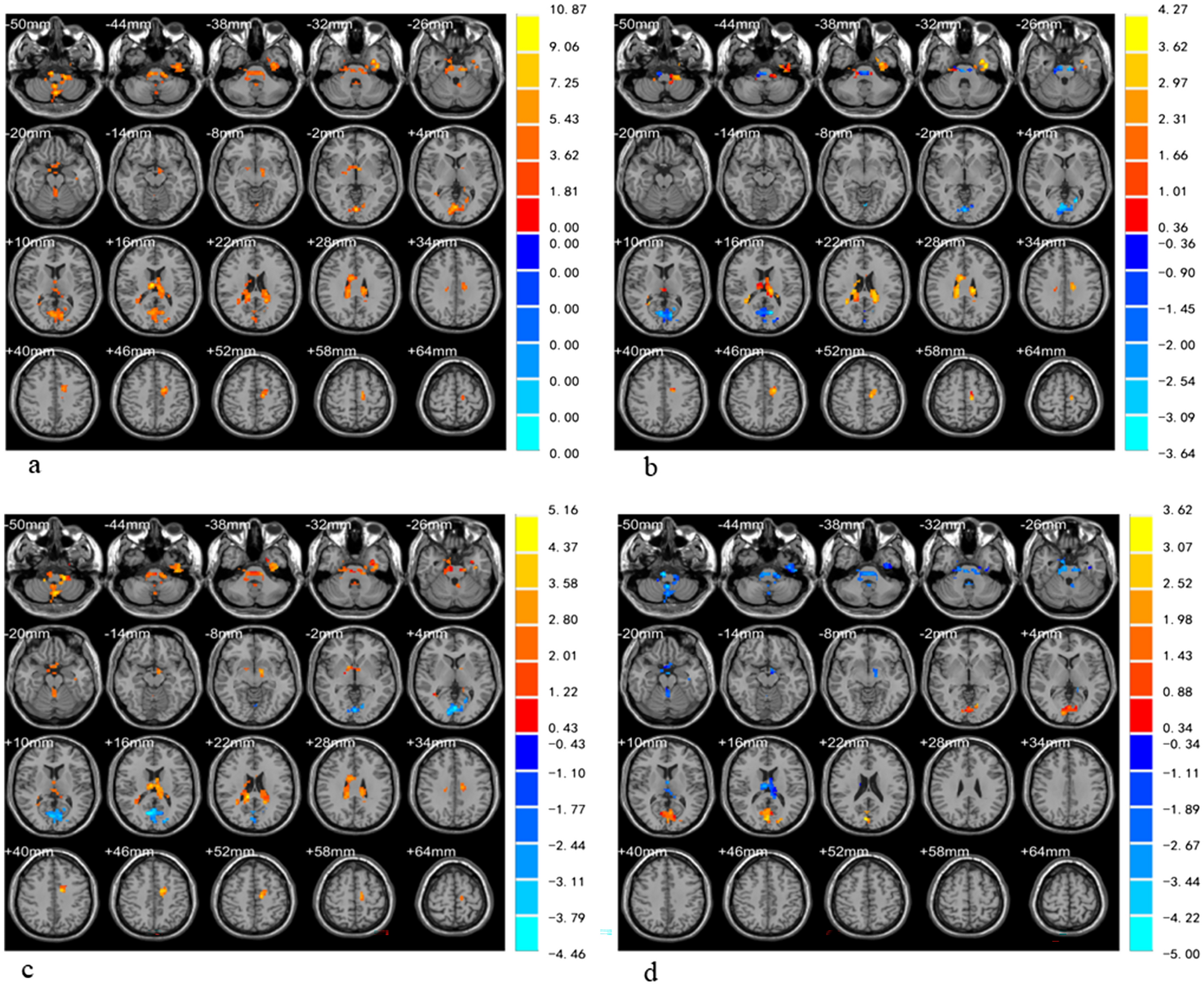 Regional homogeneity differences in resting-state fMRI between Parkinson’s disease and multiple system atrophy-parkinsonian type
