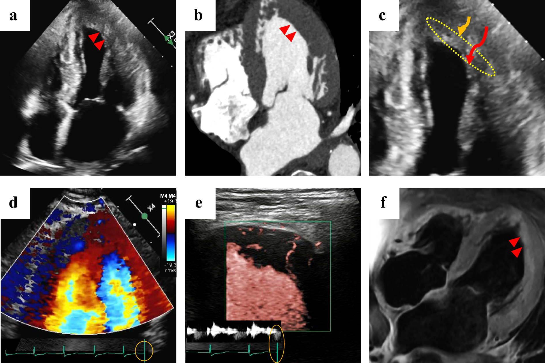 Utility of superb microvascular imaging in evaluating intracardiac thrombus in Loeffler endocarditis