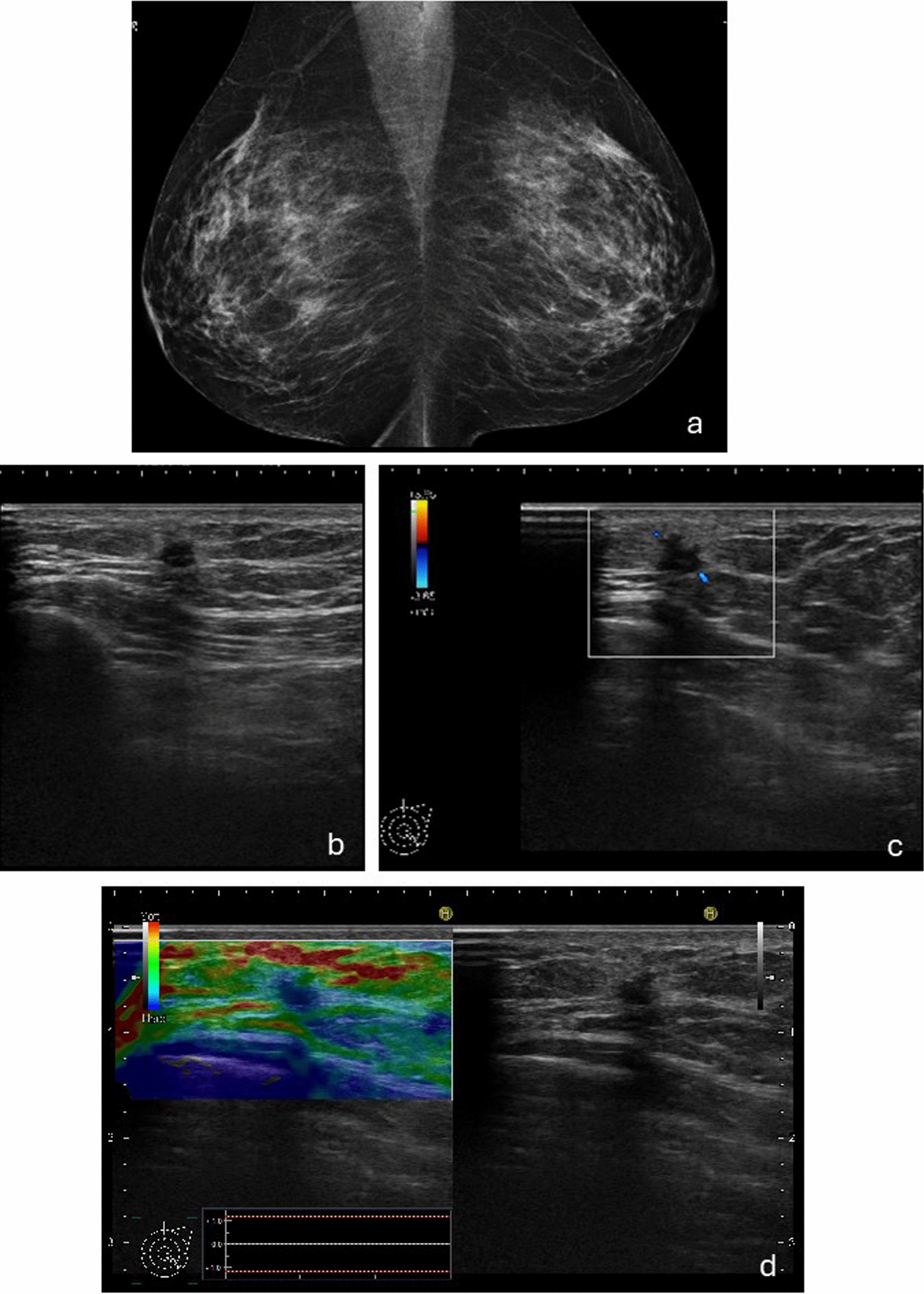 A case of nodular fasciitis that appeared in the breast and required differentiation from a malignant tumor