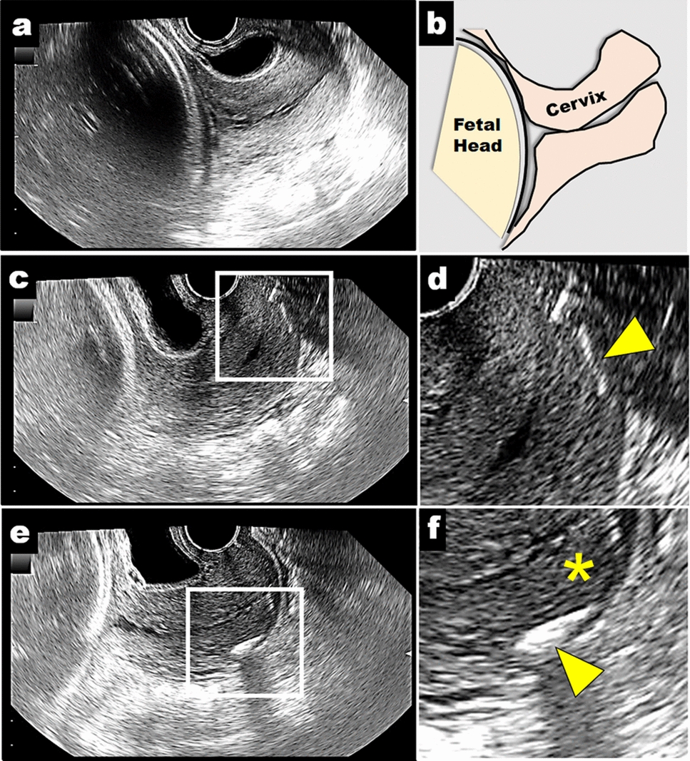 Ultrasound-guided insertion of controlled-release dinoprostone vaginal delivery system (PROPESS)