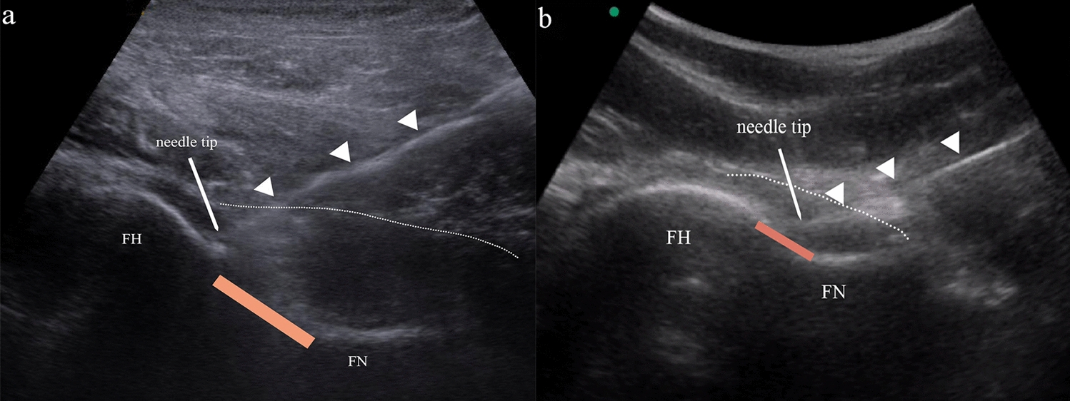 Anterolateral hip injection approach under portable ultrasound guidance: a prospective randomized controlled trial versus conventional ultrasound