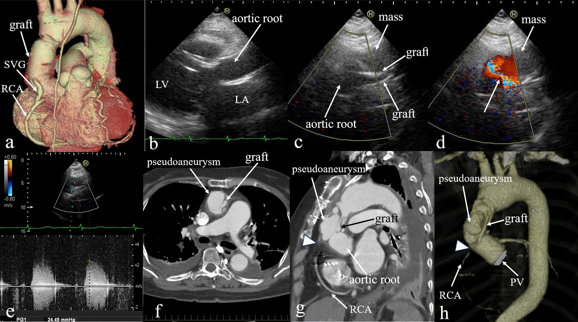 Supravalvular aortic stenosis caused by compression of a pseudoaneurysm late after aortic root replacement