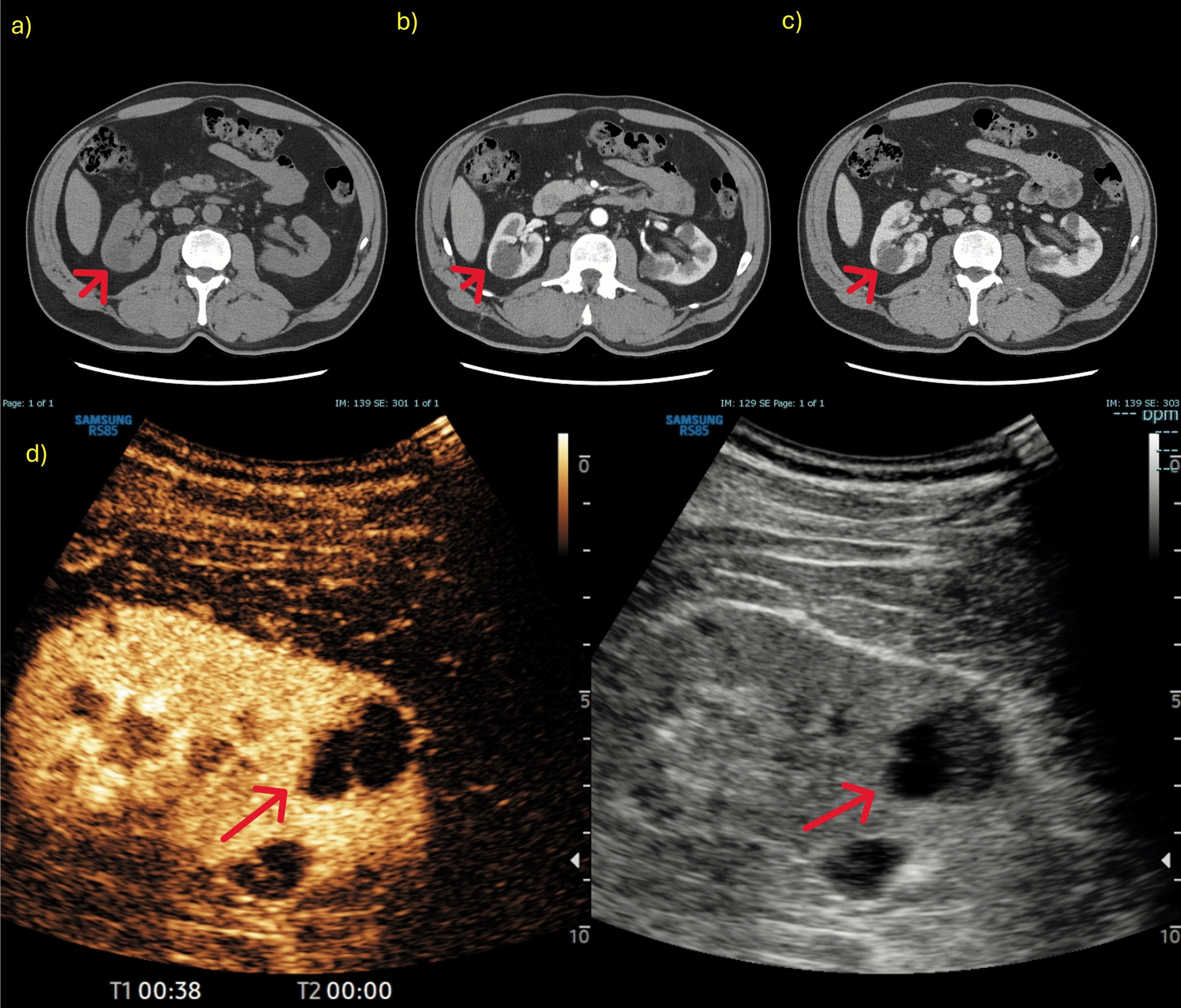 Contrast-enhanced ultrasound in the evaluation and management of solid renal lesions based on EFSUMB guidelines