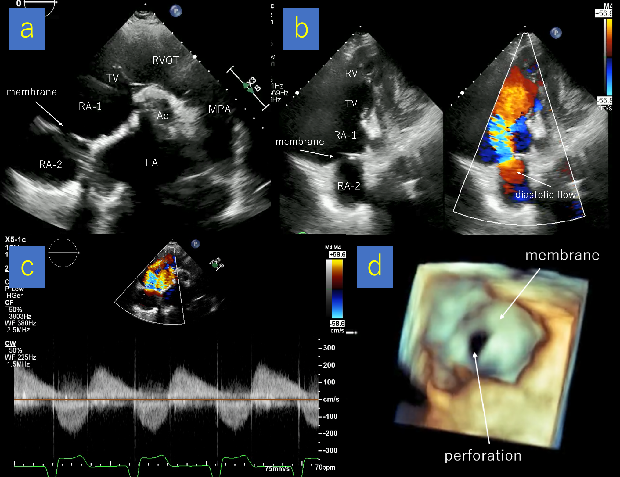 Asymptomatic cor triatriatum dexter detected decades after cardiac surgery