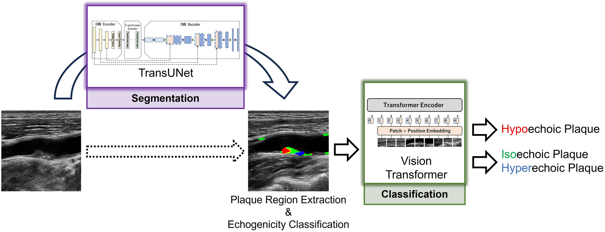 Automated scheme of plaque classification based on segmentation in carotid ultrasound images using transformer approach