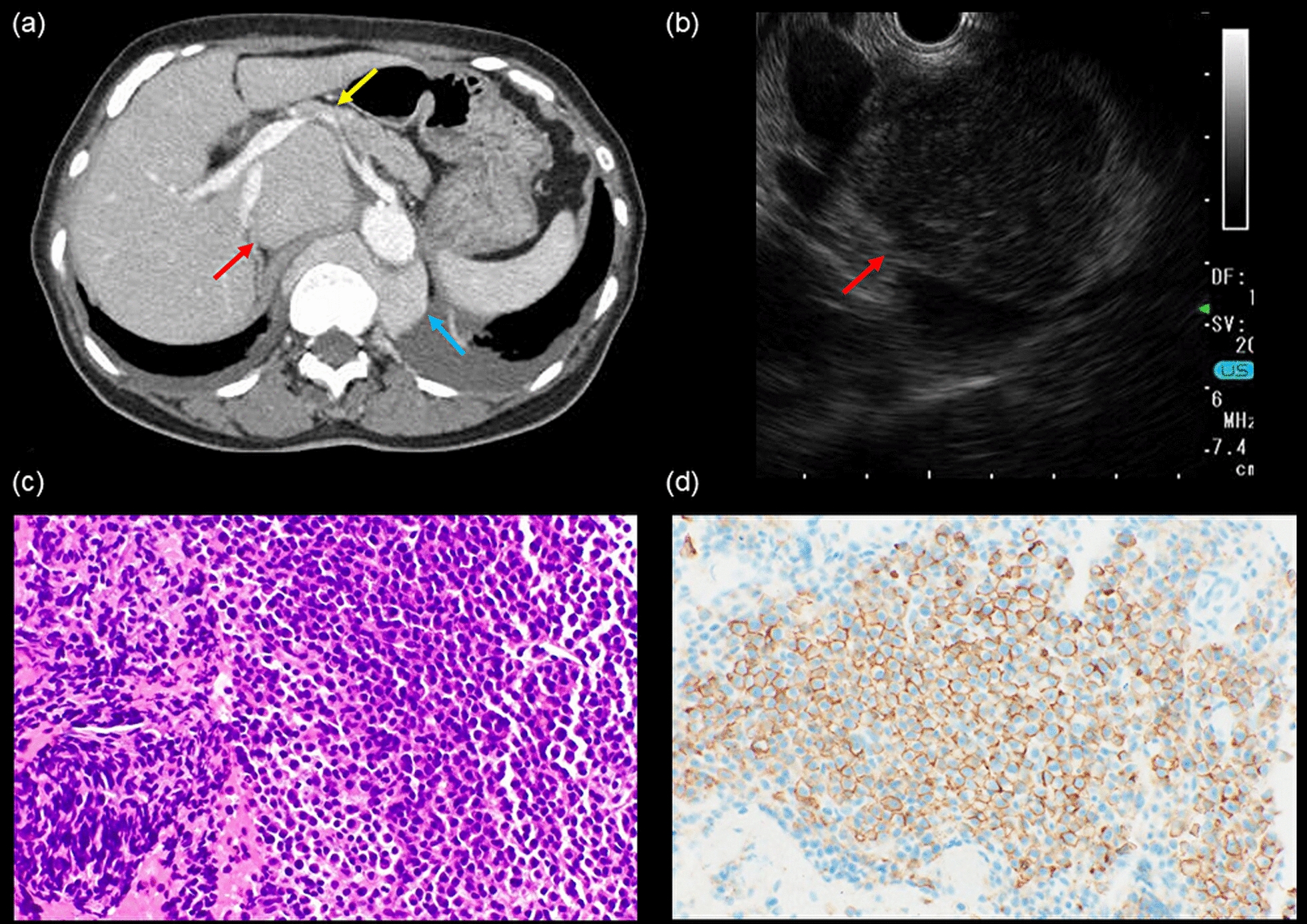 Multiple myeloma with an intra-abdominal lesion as a rare extramedullary lesion diagnosed with endoscopic ultrasound-guided tissue acquisition