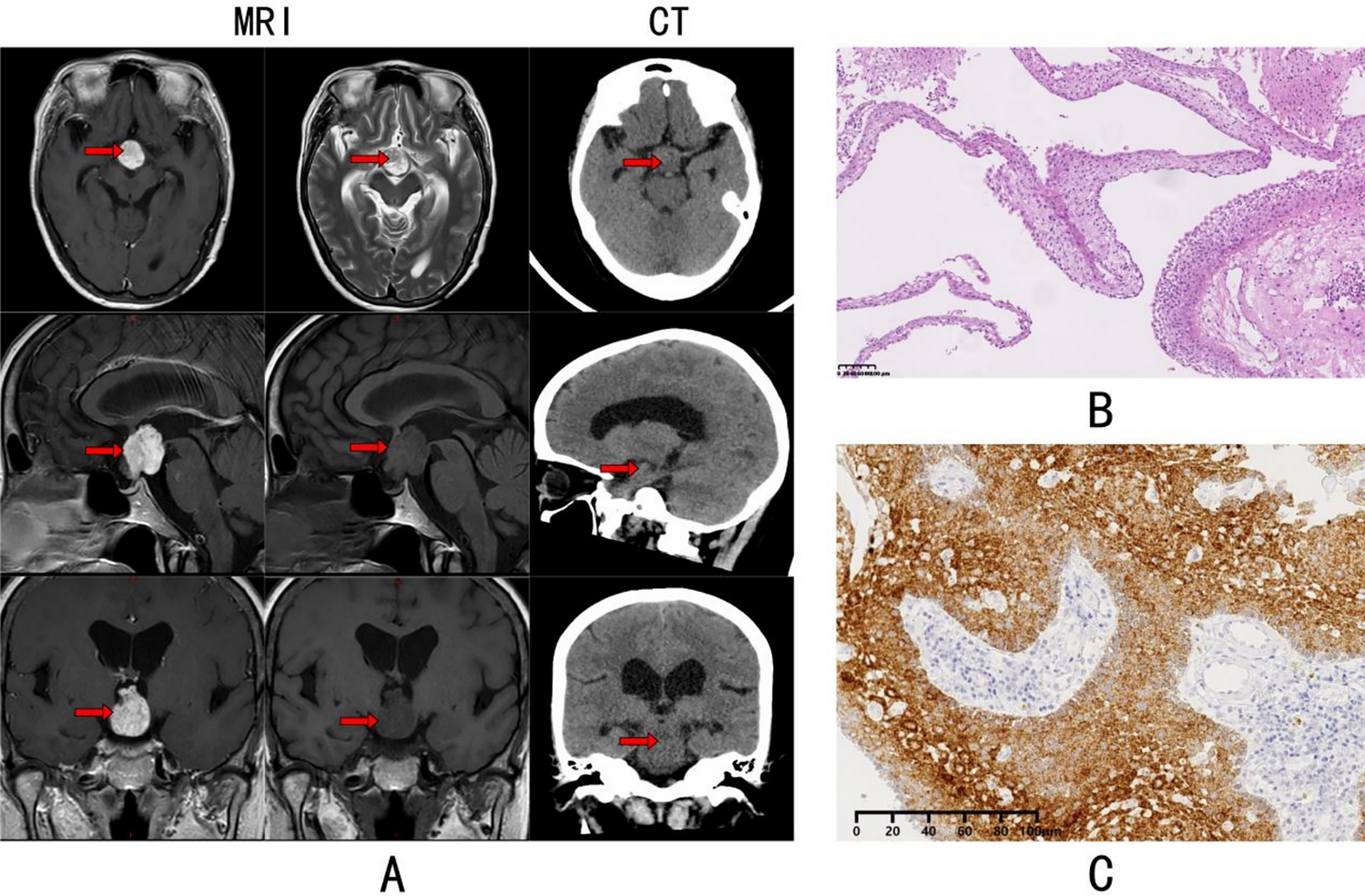 Targeted therapy of papillary craniopharyngioma