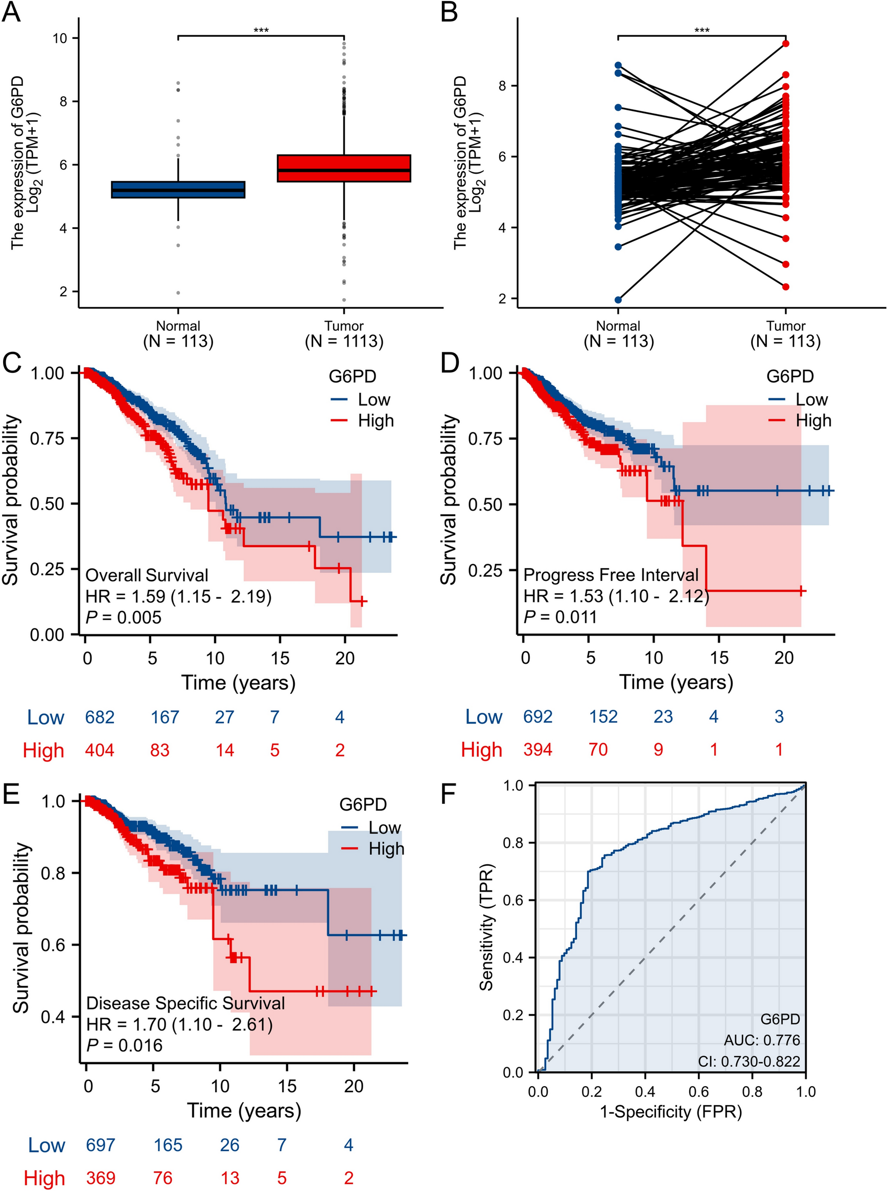 Integrating scRNA-seq and spatial transcriptomics to explore the implication of G6PD on immune microenvironment in lymphatic metastasis of breast cancer