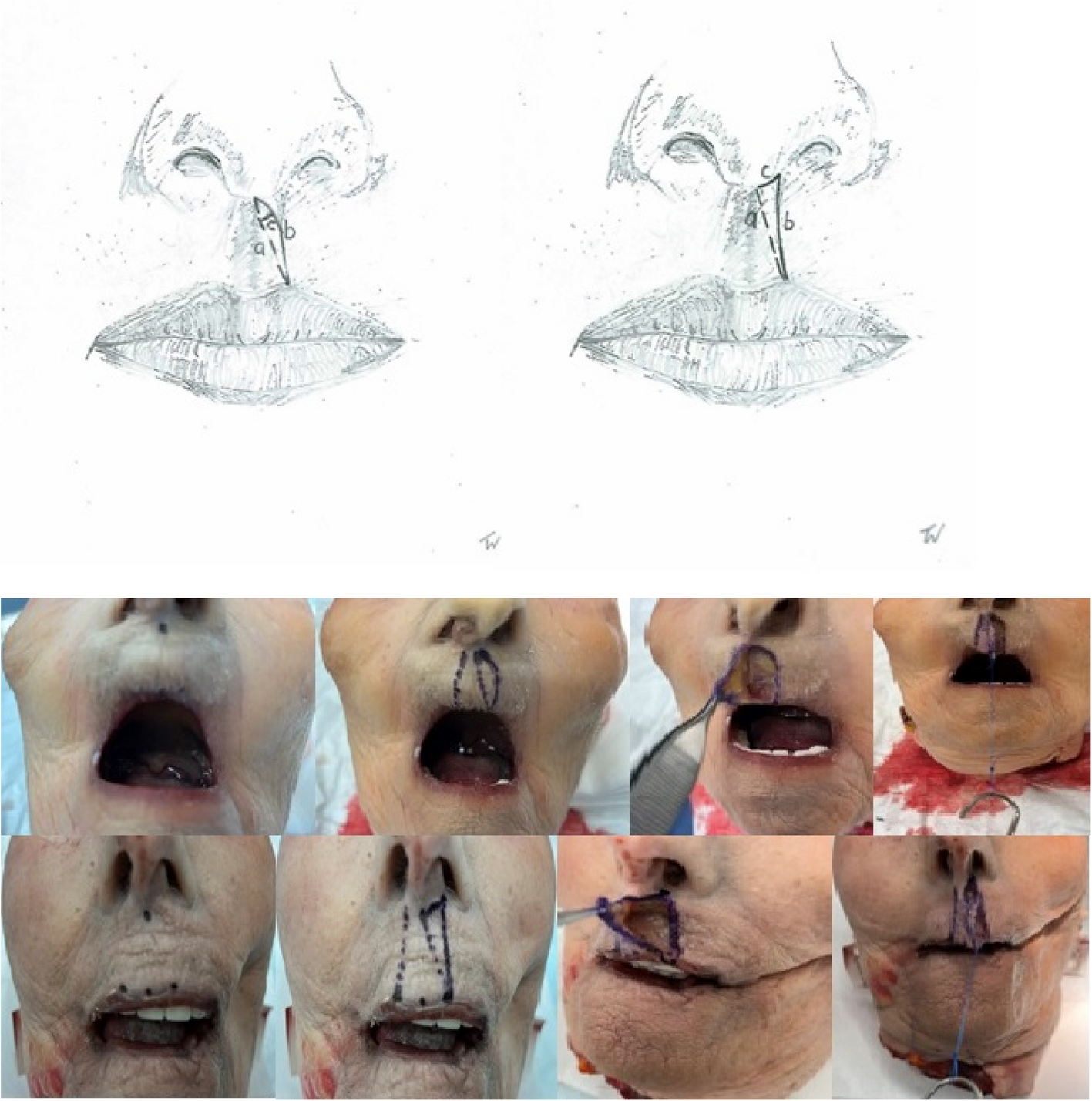Z-back-cut cheiloplasty: a cadaveric and clinical study on lip lengthening in unilateral cleft lip repair as a proof of concept