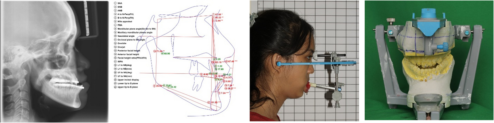 Comparison of accuracy of maxilla between virtual surgical planning and conventional surgical planning in bimaxillary orthognathic surgery: a randomized controlled trial