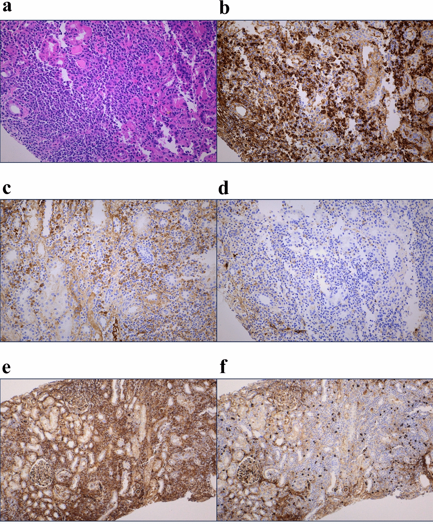 Tubulointerstitial nephritis with predominant monotypic plasma cell infiltration in three cases of Sjögren's syndrome: case reports and literature review