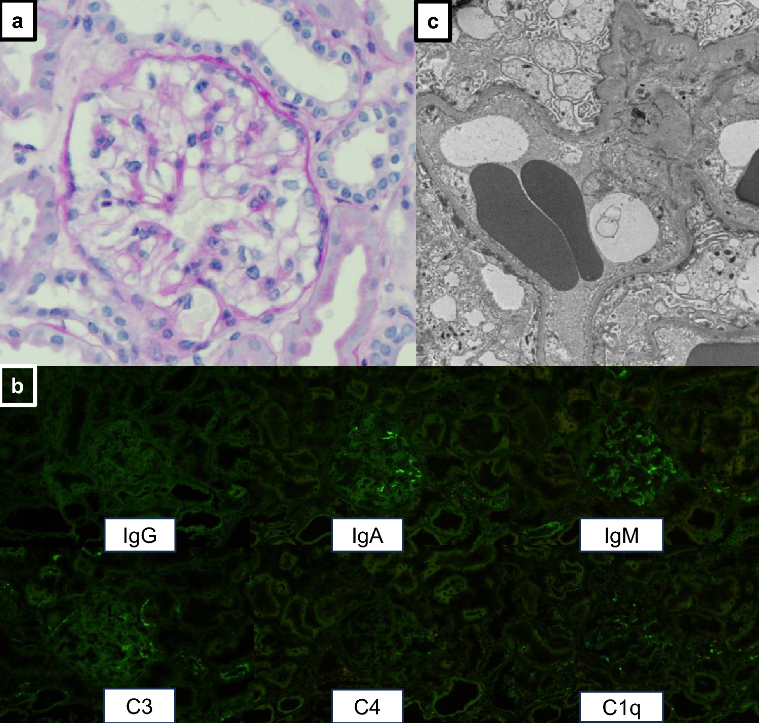 Early low-density lipoprotein apheresis for steroid-resistant minimal change disease with acute kidney injury: a case report