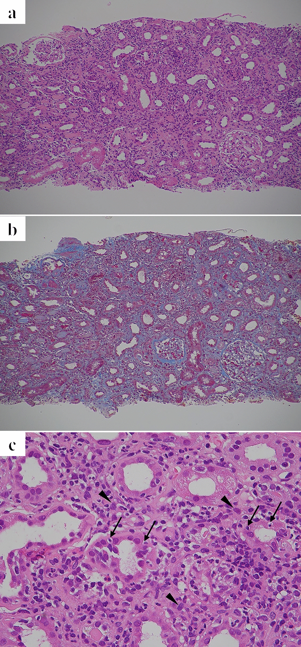A case of acute tubulointerstitial nephritis with suspected Saikokaryukotsuboreito involvement responding to glucocorticoid therapy