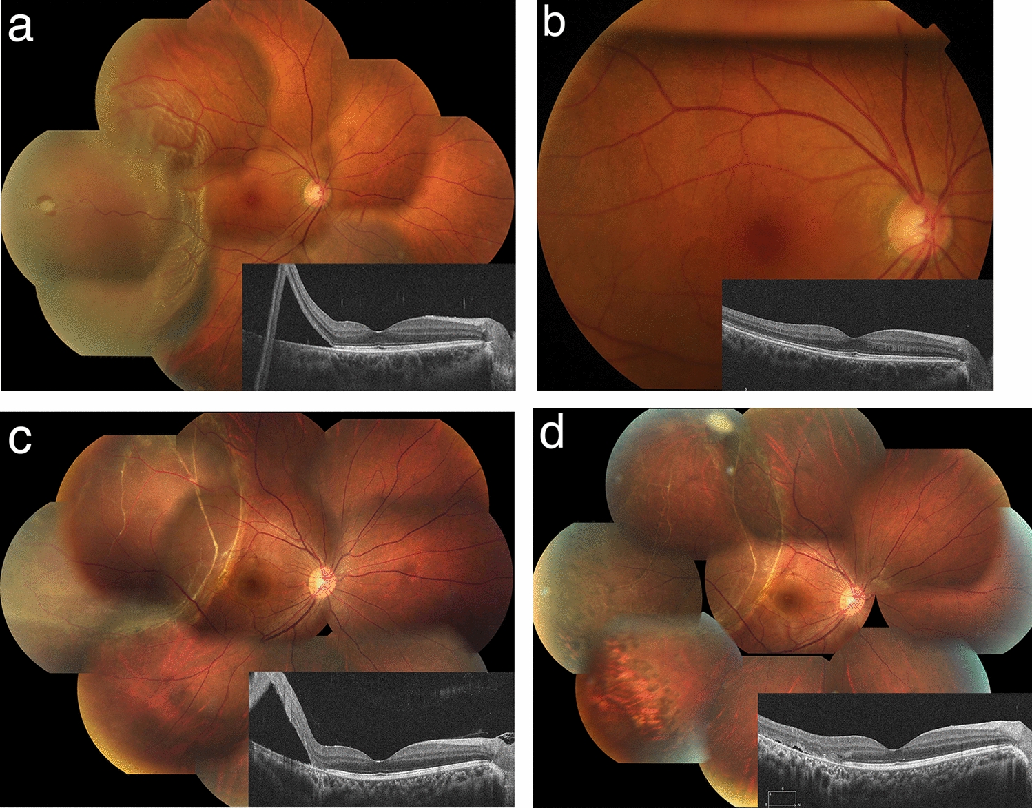 Implementation of pneumatic retinopexy in the Japanese population