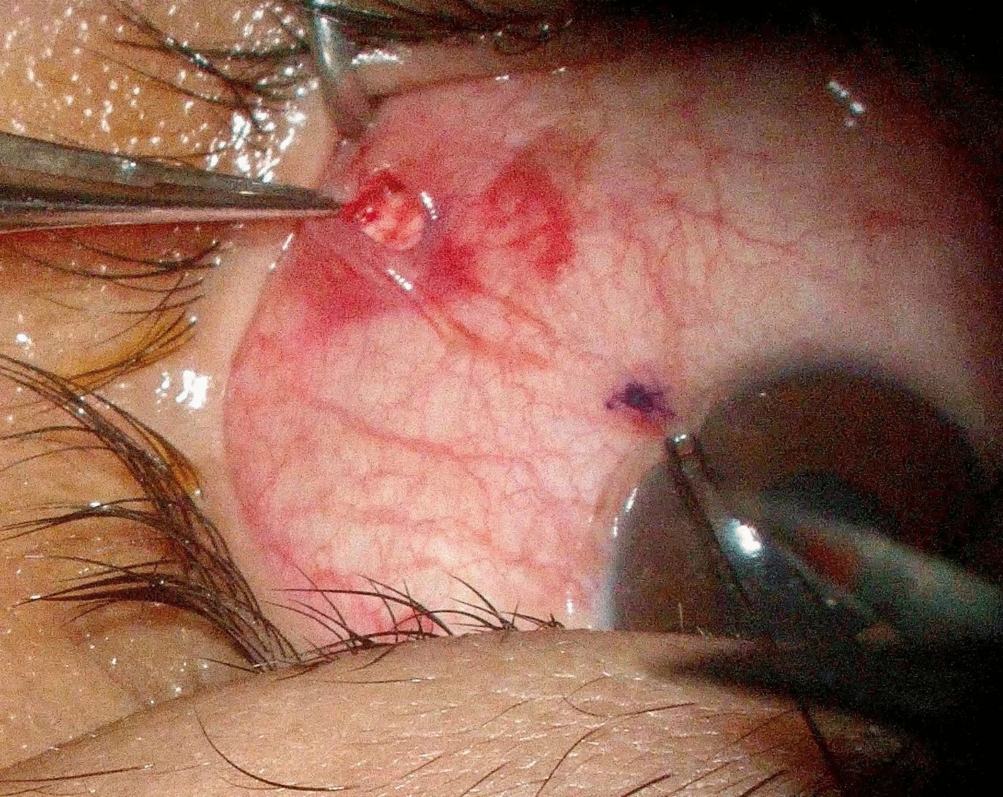 Minimally invasive strabismus surgery versus conventional surgical technique for inferior oblique recessions