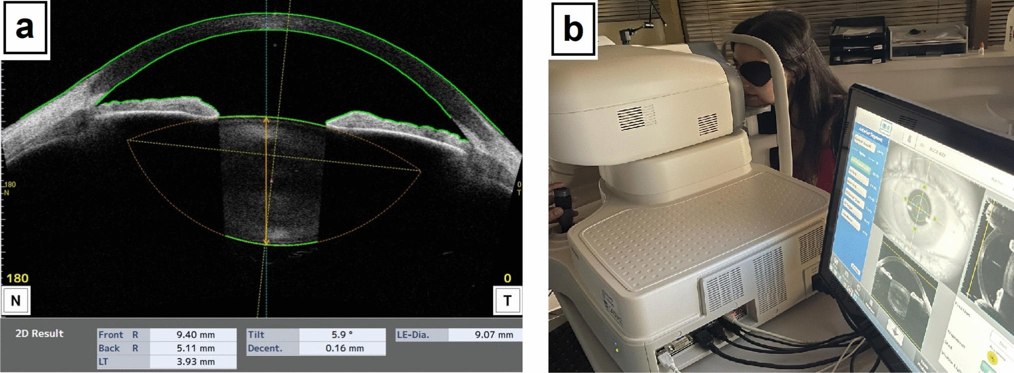 In vivo characterization of morphologic changes in the lens during accommodation as a function of age by use of OCT with swept-source technology