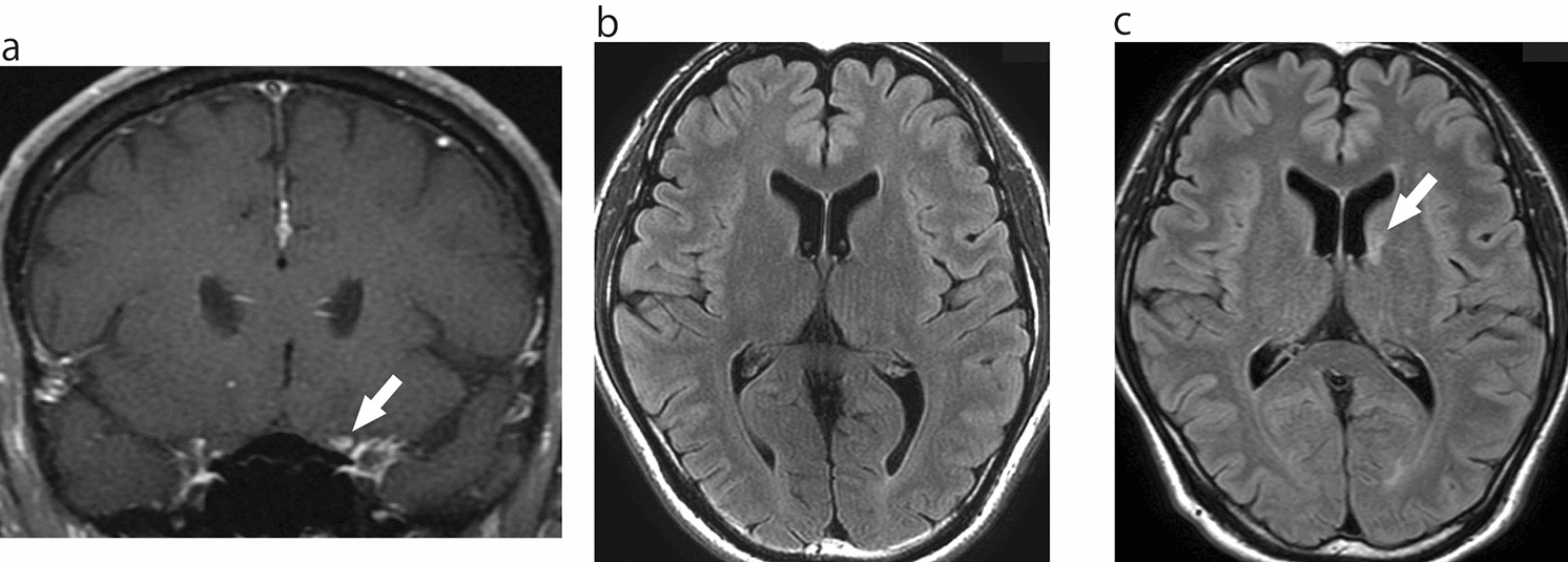 Reconsideration of conversion to multiple sclerosis: one-year cerebral lesion appearance rate of Japanese aquaporin-4 antibody-negative optic neuritis patients