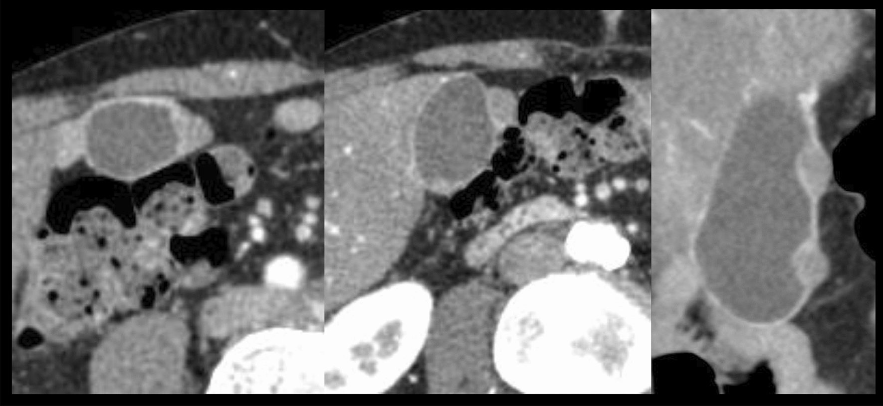 A case of gallbladder metastases with a different histologic type detected during lung cancer treatment