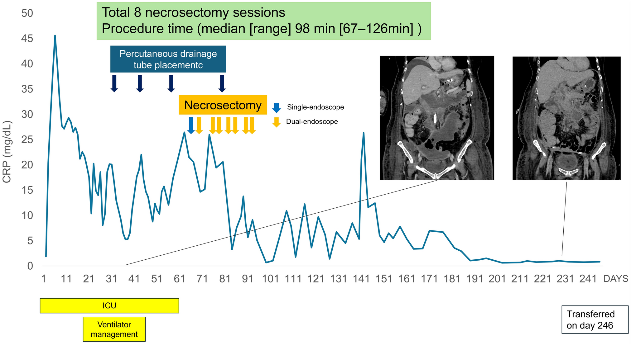 Percutaneous endoscopic necrosectomy for extensive walled-off necrosis using two endoscopes simultaneously: a report of two cases