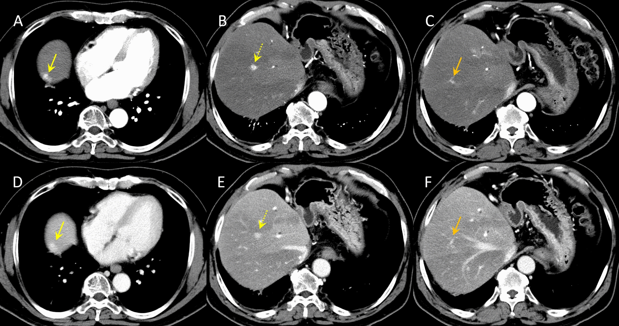 Hepatic focal nodular hyperplasia after liver transplantation: case report and review of literature