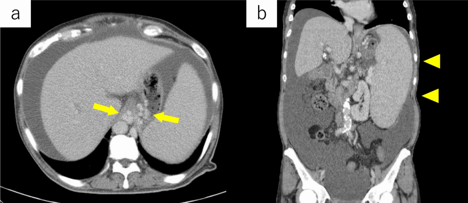 Chronic lymphocytic leukemia complicated by non-cirrhotic portal hypertension: an autopsy case report