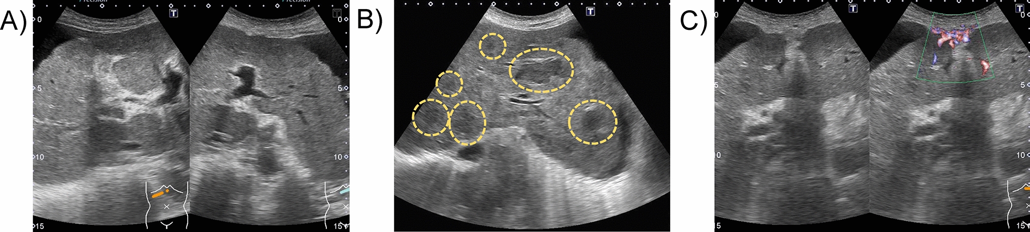 Hepatic angiosarcoma presenting with clinical features of decompensated cirrhosis