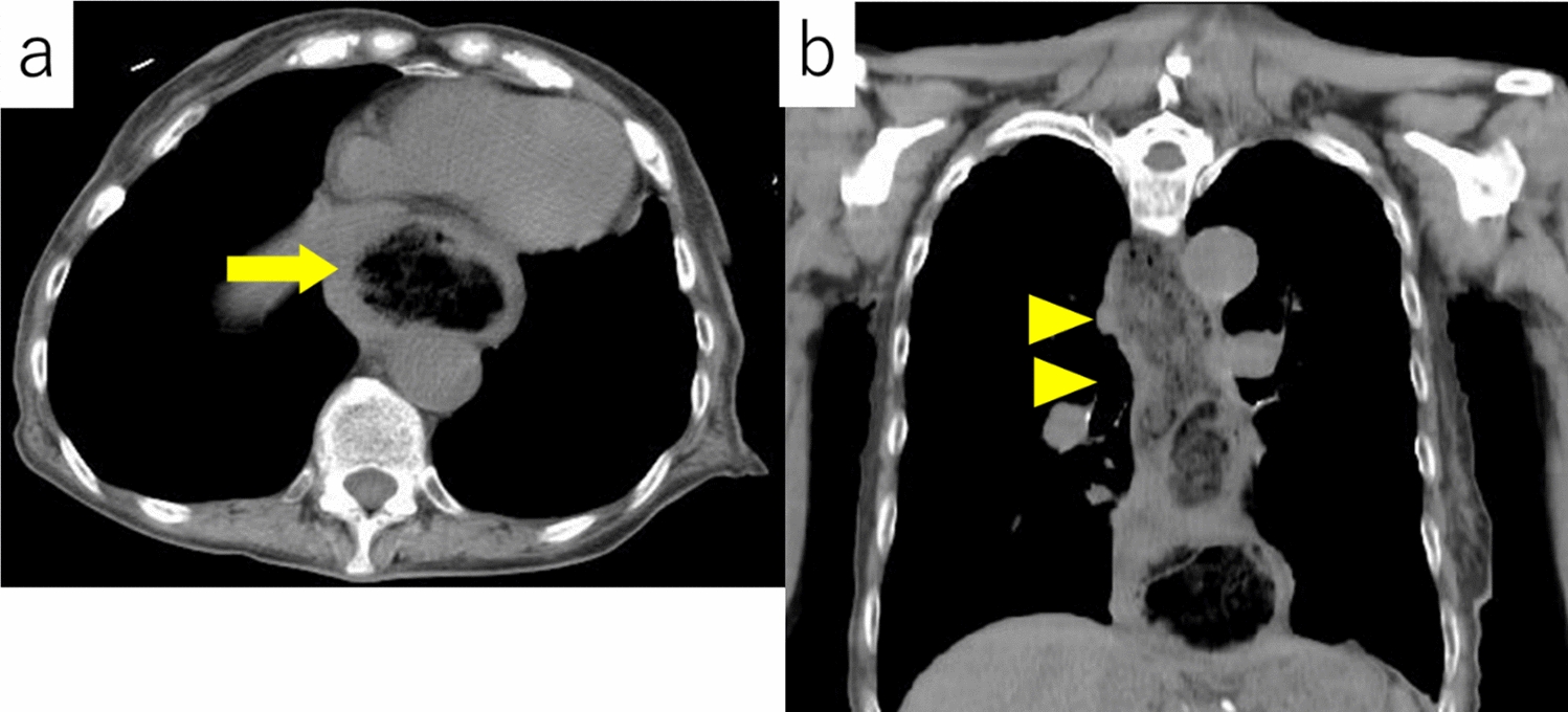 Successful endoscopic removal of an impacted esophageal sponge in an elderly woman with dementia