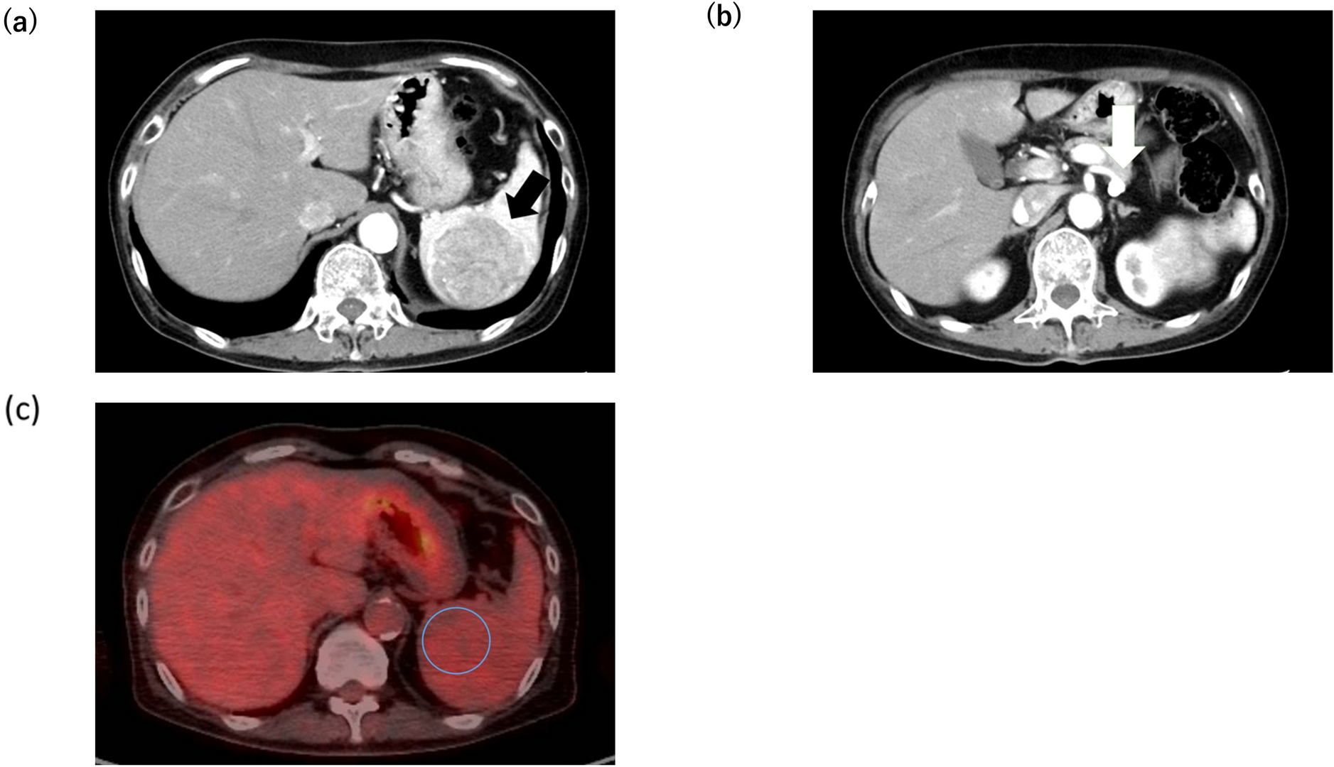 Sclerosing angiomatoid nodular transformation of the spleen with thrombocytopenia