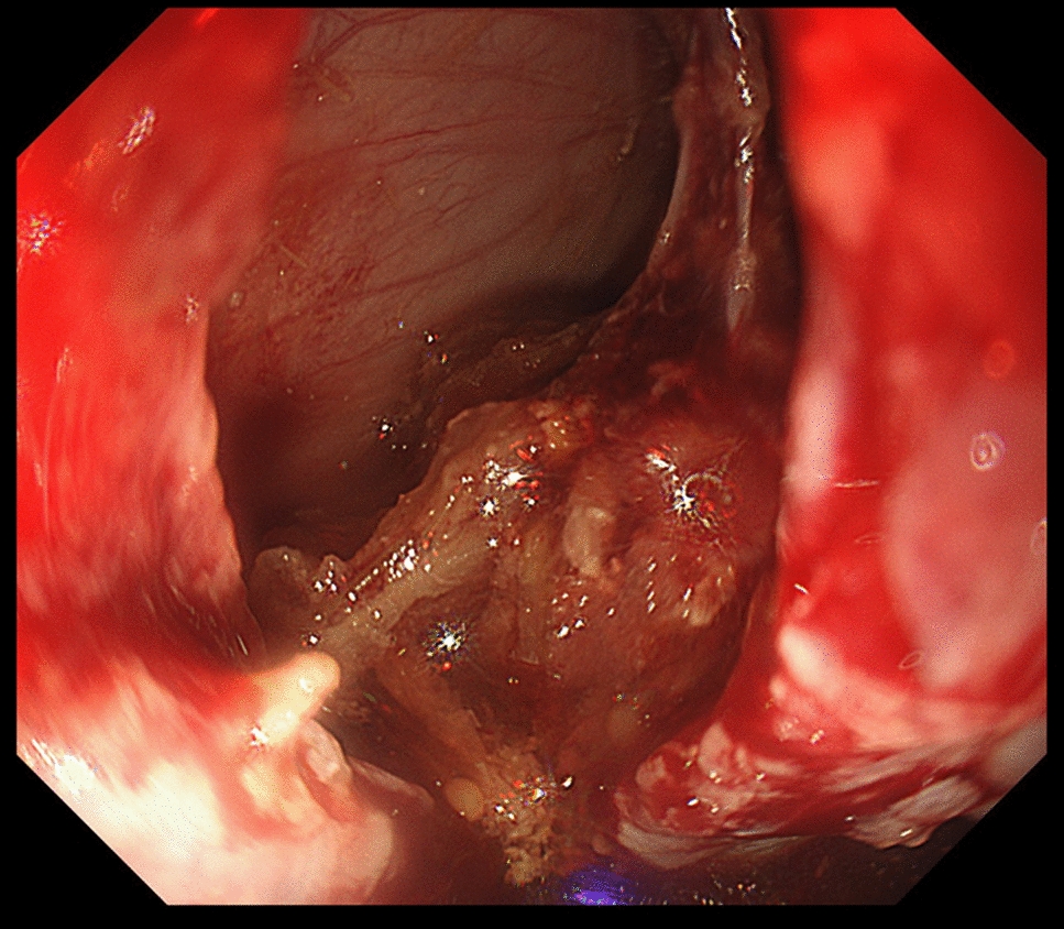 Endoscopic closure of 5-cm long esophageal perforation in an elderly patient with achalasia