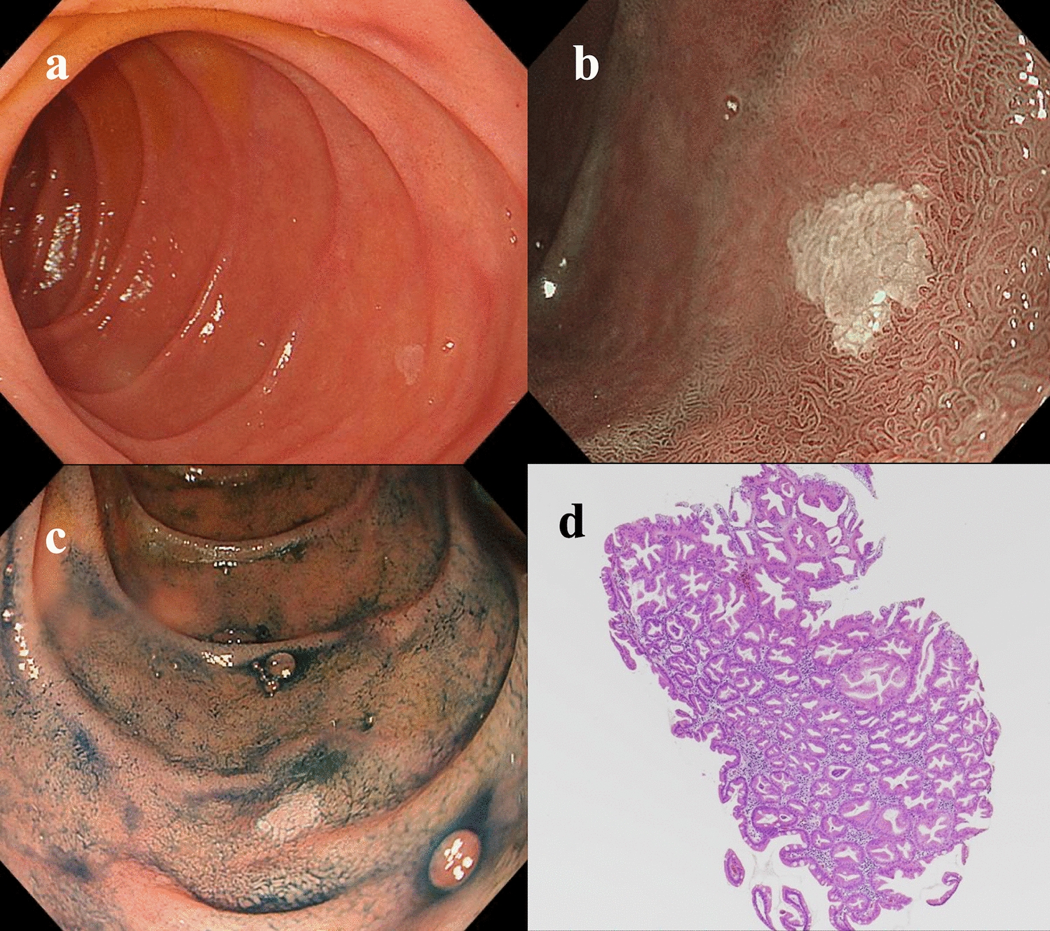 Two duodenal sessile serrated lesions in a patient with serrated polyposis syndrome: case report and review of the literature
